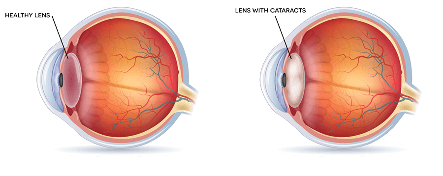 A diagram representing two eyes where one needs eye cataract surgery in Overland Park, KS