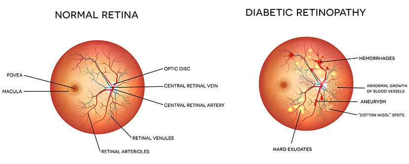 Chart Showing a Healthy Retina Compared to One With Diabetic Retinopathy