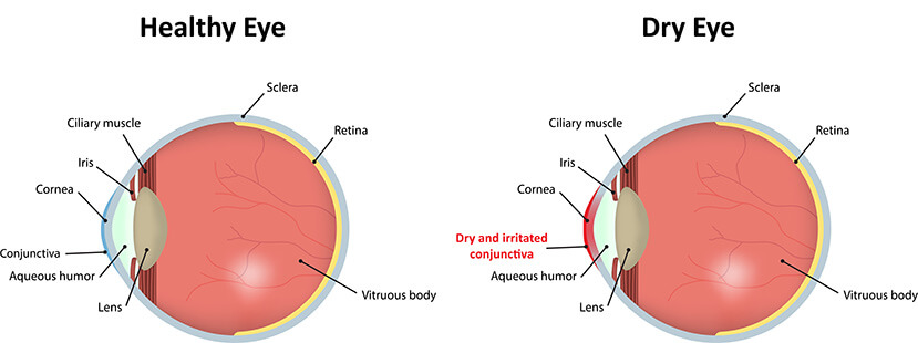 Chart Showing a Healthy Eye Compared to One With Dry Eye