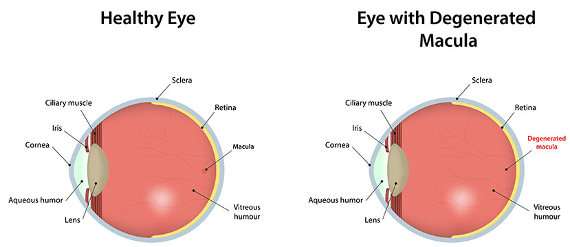 Chart Showing a Healthy Eye Compared to One With Degenerated Macula