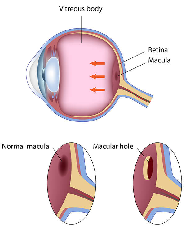 Chart Showing a Macular Hole in an Eye