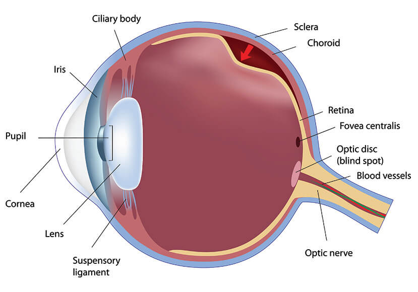 Chart Illustrating a Retinal Detachment in an Eye